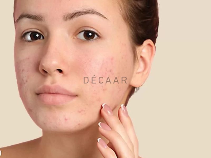 Cách điều trị mụn không nhân